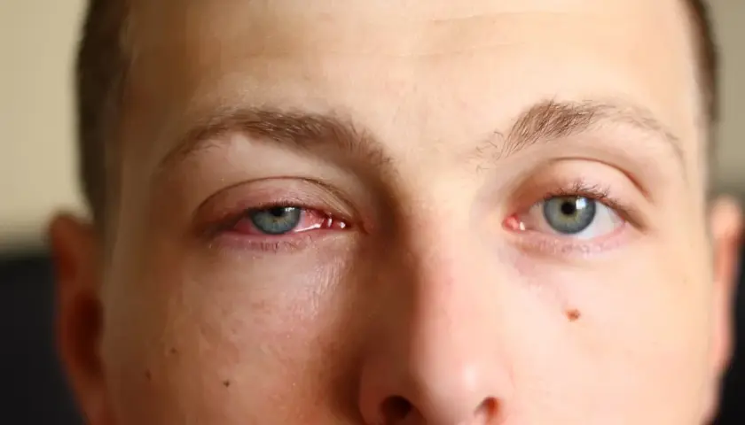 Œil rouge et irrité, signe de conjonctivite. Que faire pour soulager cette gêne ?
