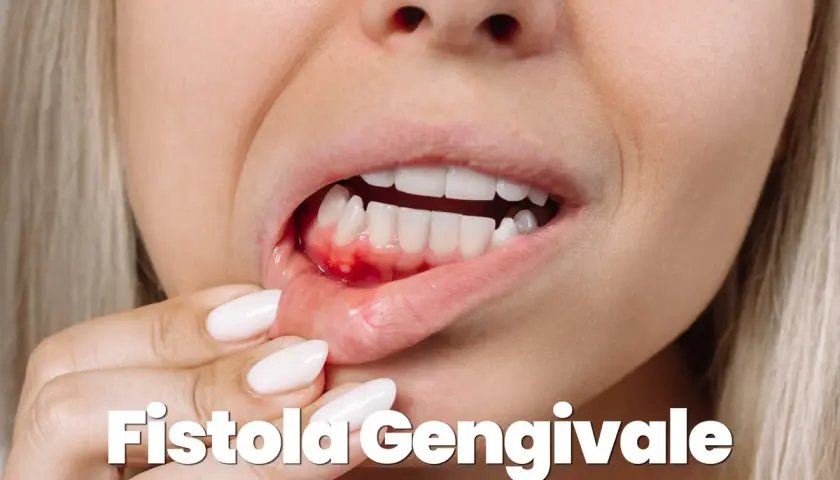 Dettaglio di una bocca con gengiva infiammata e gonfia, con piccole pustole. Potrebbe indicare una fistola gengivale, un sintomo da non sottovalutare, a volte associato a problemi più seri come un tumore.