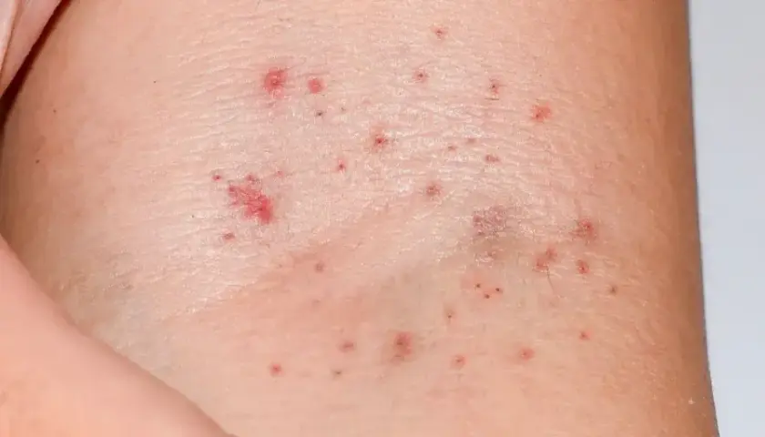Pelle con piccole macchie rosse, che potrebbero indicare petecchie. Cosa sono? Piccoli sanguinamenti sotto la pelle.