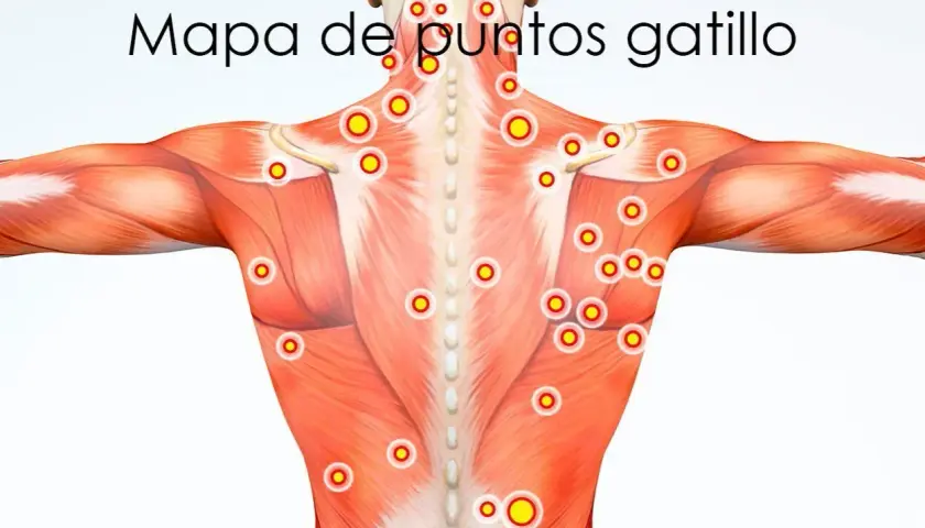 Mapa de puntos gatillo en la musculatura de la espalda y hombros.