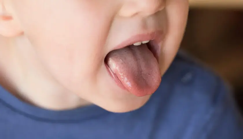 Dziecko pokazuje język z białym nalotem. Szukamy pypeć na języku domowe sposoby.
