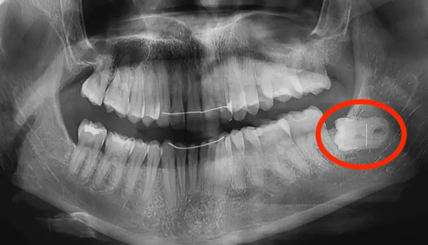 Radiografia dentale mostra un dente cariato, evidenziato in rosso. Fa male togliere una carie, ma è necessario per la salute orale.