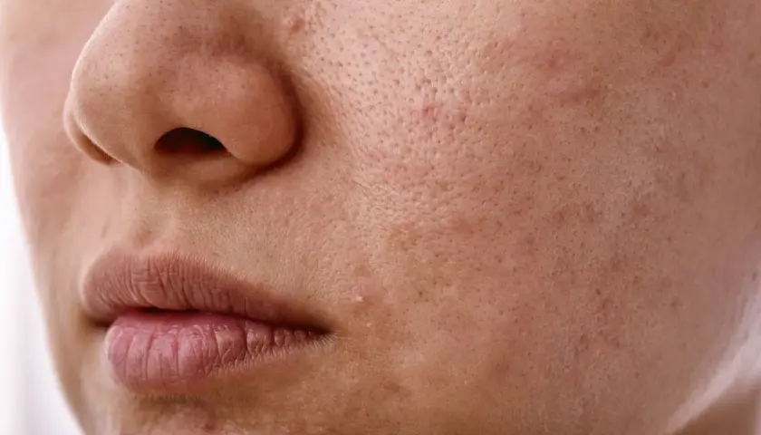 Skóra z widocznymi porami i niedoskonałościami. Nadmiar sebum może prowadzić do takich zmian.