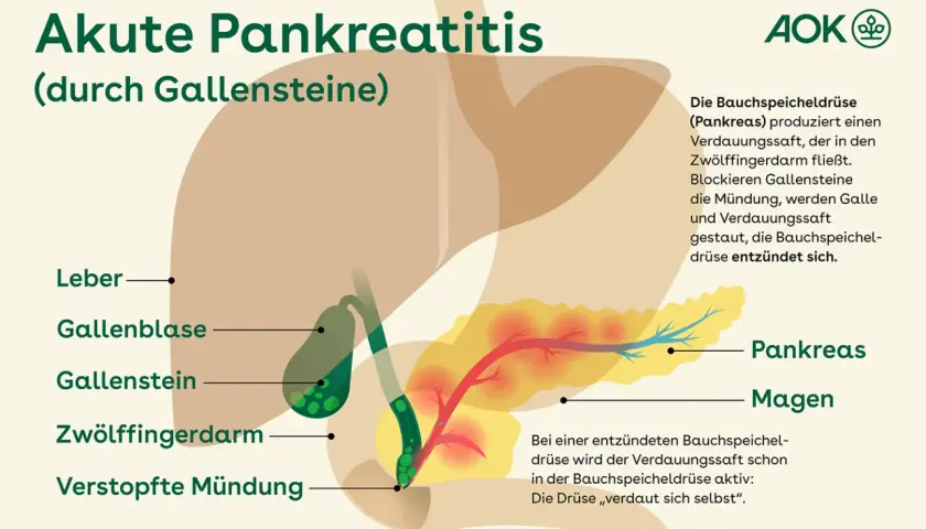 Illustration zeigt Gallensteine, die die Mündung blockieren und eine akute Pankreatitis auslösen. Symptome können durch diese Blockade entstehen.
