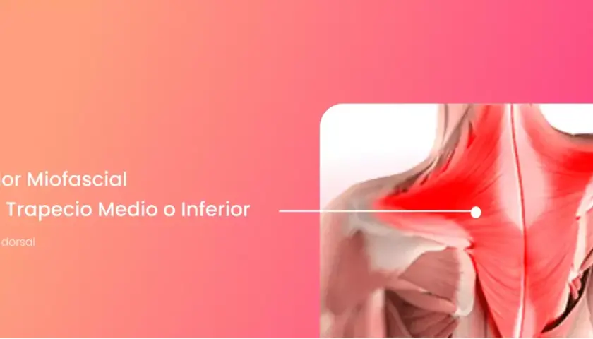 Dolor miofascial en el trapecio medio o inferior, con área inflamada en rojo.