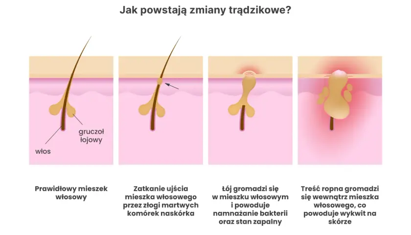 Ilustracja pokazuje, jak powstaje trądzik bakteryjny: zatkanie mieszka włosowego, namnażanie bakterii i stan zapalny prowadzący do ropnych wykwitów.