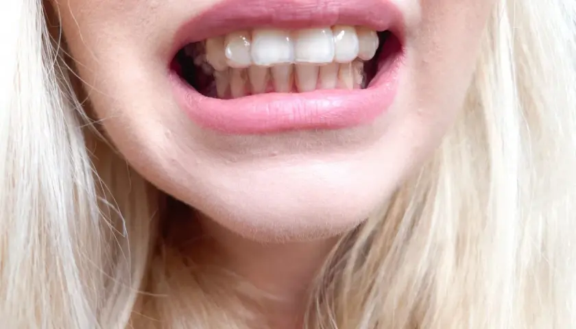 Uśmiech z widocznymi, przezroczystymi nakładkami Invisalign na zębach.
