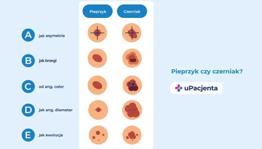 Porównanie pieprzyka i czerniaka: asymetria, brzegi, kolor, średnica i ewolucja. Zwróć uwagę na swędzący pieprzyk.