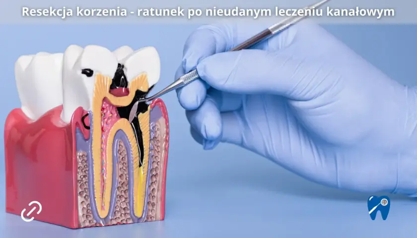Model zęba z widocznym uszkodzeniem po leczeniu kanałowym. Dłoń w rękawiczce stomatologicznej wykonuje zabieg resekcji wierzchołka korzenia.