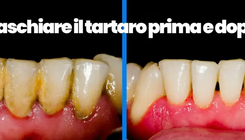 Denti con tartaro sottogengivale prima e dopo la pulizia.
