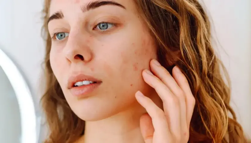 Une jeune femme aux yeux bleus touche son visage, marqué par des rougeurs et des imperfections. Elle cherche à hydrater le visage pour retrouver une peau nette.