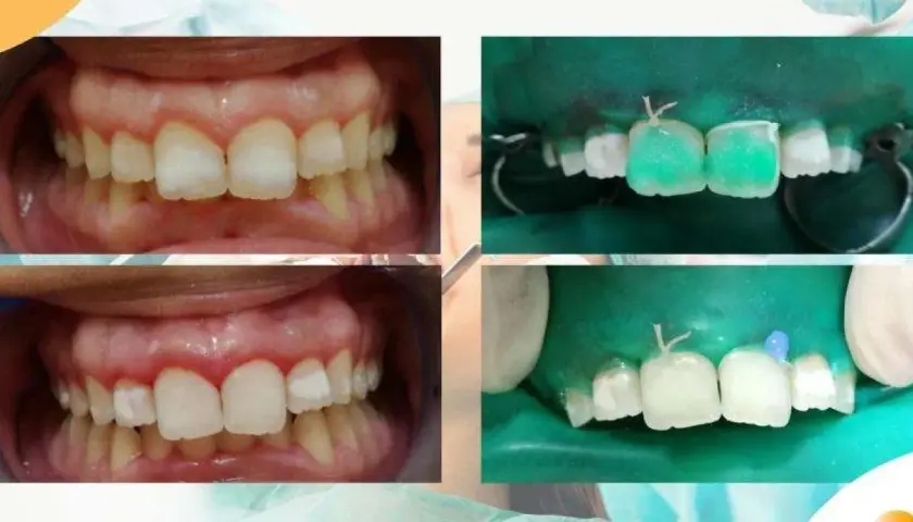 Denti con macchie bianche prima e dopo il trattamento. Si vedono i denti preparati e isolati con diga di gomma, pronti per il restauro.