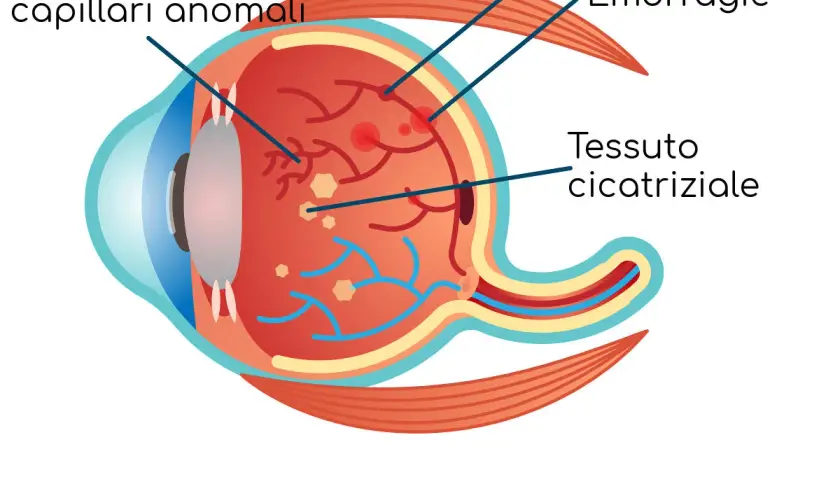Illustrazione dell'occhio che mostra i danni della retinopatia diabetica: capillari anomali, emorragie e tessuto cicatriziale.
