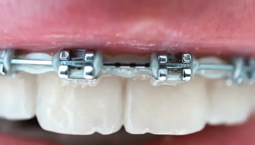 Zbliżenie na zęby z metalowym aparatem ortodontycznym. Widać metalowe zamki i łuk, ale brak kolorowych gumek.