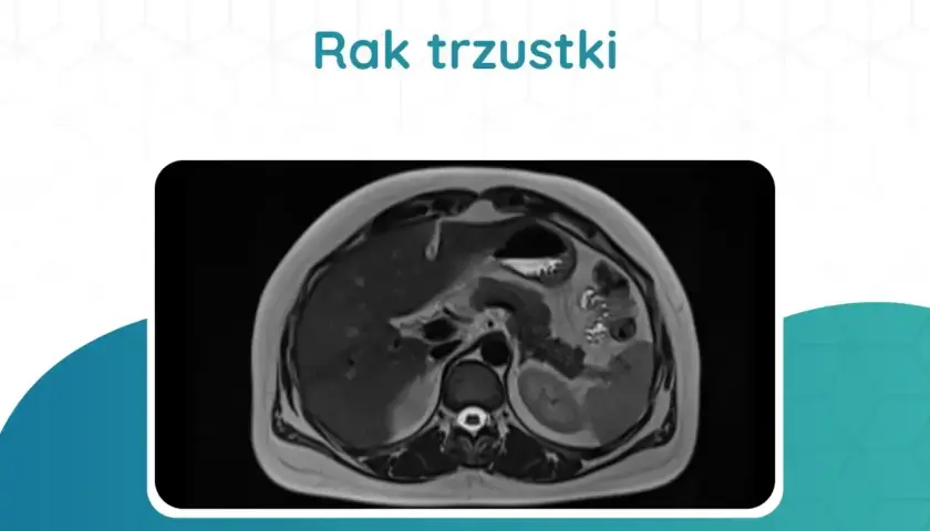 Tomografia rezonansu magnetycznego jamy brzusznej, ukazująca obraz raka trzustki. Jakie badania na trzustkę są kluczowe w diagnostyce.