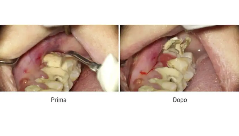 Prima e dopo la rimozione di un **tartaro grave**. La gengiva è infiammata e i denti sono coperti da depositi giallastri.