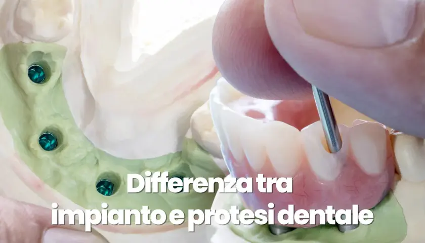 Modello dentale con impianti e una protesi dentale in fase di lavorazione.