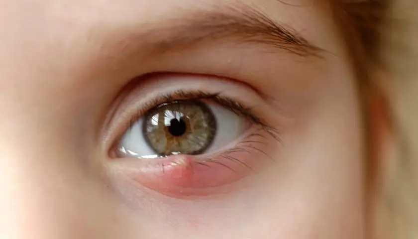 Un œil avec un bouton rouge et gonflé au coin de l'œil, près des cils.