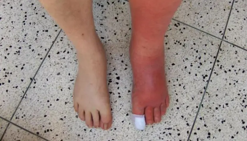 Choroba tkanki łącznej objawy – jak je rozpoznać i co oznaczają