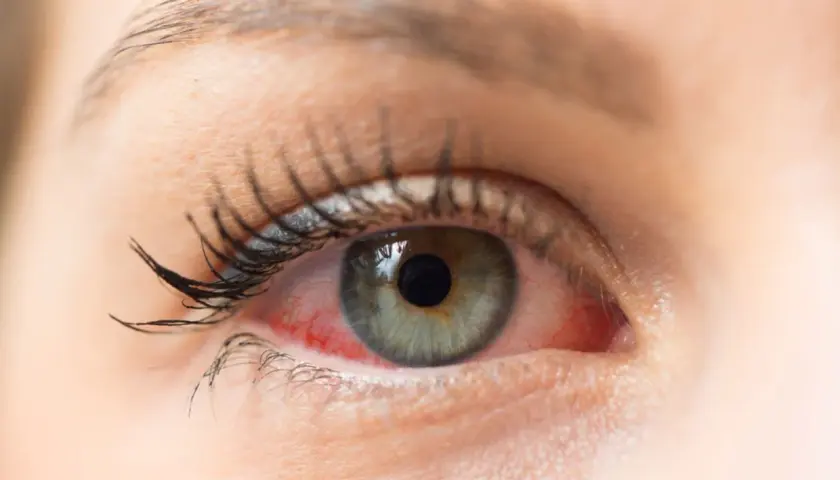 Rotes, gereiztes Auge mit sichtbaren Äderchen. Vielleicht ein Fall für Bindehautentzündung Hausmittel?