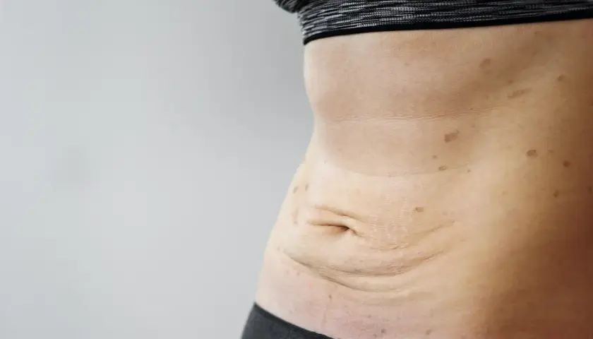Luźna skóra po schudnięciu 20 kg, widoczne rozstępy i przebarwienia na brzuchu.