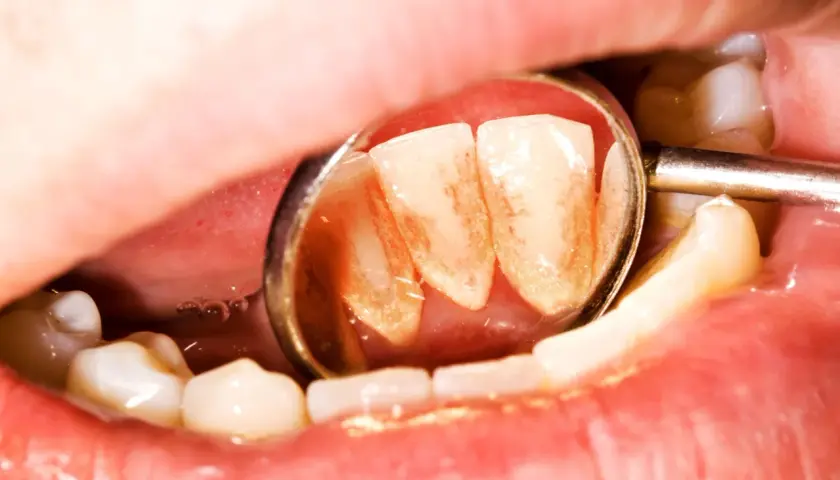Widok zęba z widocznym kamieniem, odbitym w lusterku dentystycznym.