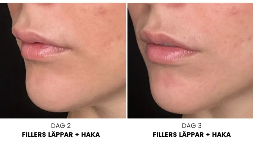 Före- och efterbilder av läppar och haka efter konsultation med fillers. Dag 2 och dag 3 visar en tydlig förbättring.