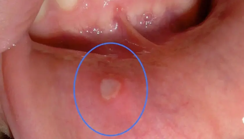 Una vescica sulla lingua, evidenziata da un cerchio blu, appare come una piccola lesione bianca circondata da rossore.