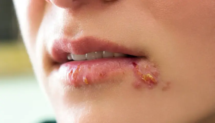 Gros plan sur une bouche avec une cloque sur la lèvre inférieure, montrant des lésions rouges et croûteuses.