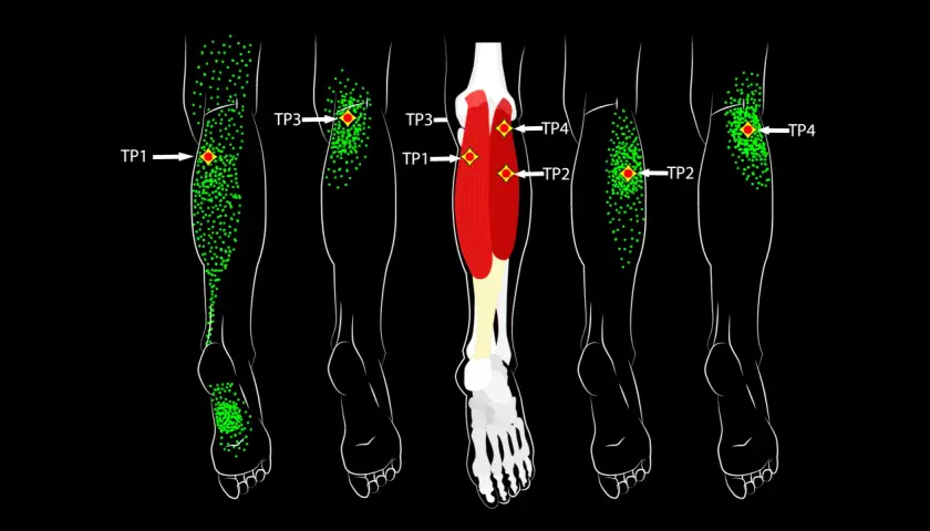 Schéma des jambes montrant des points verts indiquant des zones de douleur et des points rouges marquant la zone gâchette.
