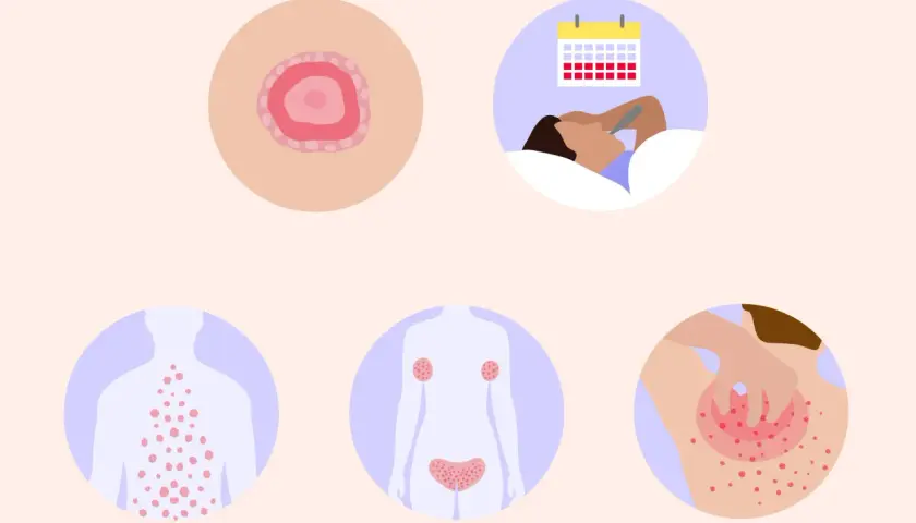 Immagine illustra la pitiriasi rosea di Gibert, con un medaglione iniziale, eruzione cutanea diffusa, e un'icona che suggerisce stress e malessere.