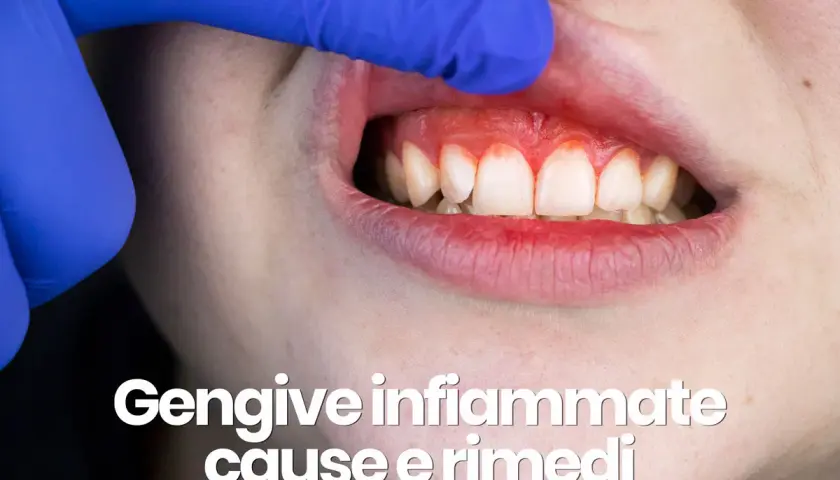 Dente con gengive rosse e gonfie, segno di dolore alle gengive che non passa. Esplorazione con guanto blu.