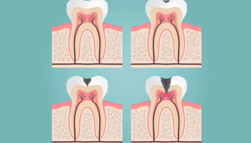 Ilustración de un diente con caries progresiva, mostrando la necesidad de un empaste o endodoncia para salvarlo.