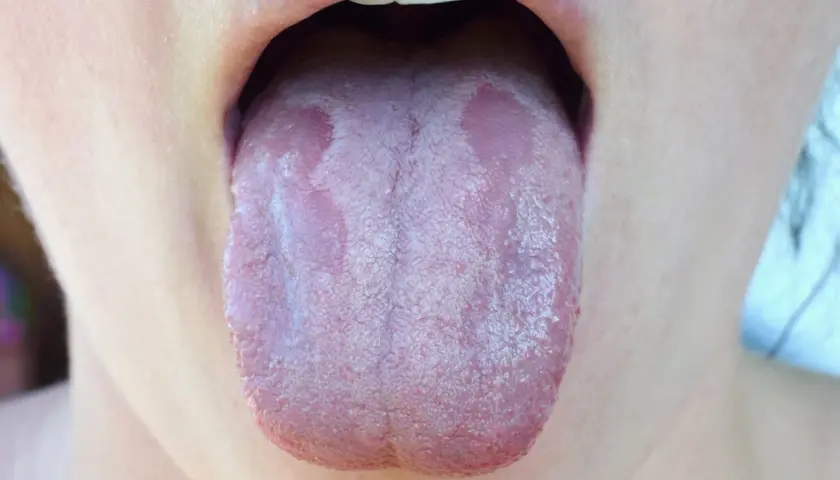 Lingua con placche biancastre, suggestive di candida lingua.