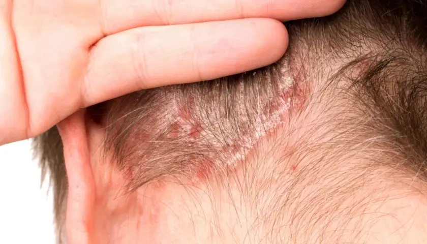 Una mano cubre parte de la cabeza, revelando un cuero cabelludo irritado con enrojecimiento y escamas blancas.