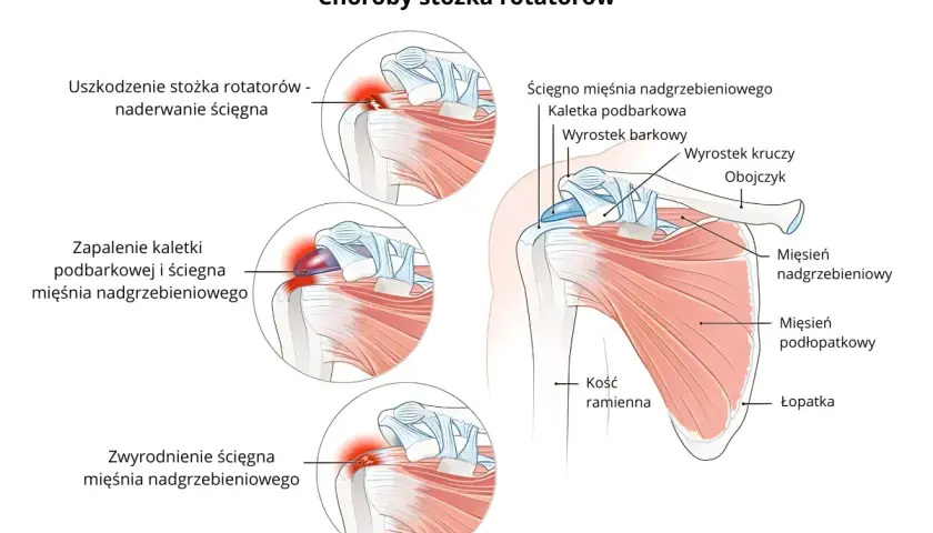 Ilustracja pokazuje budowę barku i schorzenia stożka rotatorów, w tym uszkodzenie, zapalenie i zwyrodnienie ścięgna mięśnia nadgrzebieniowego.