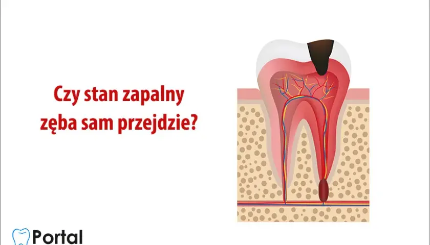 Stan zapalny zęba: Objawy, leczenie, koszty. Czy da się go uniknąć?
