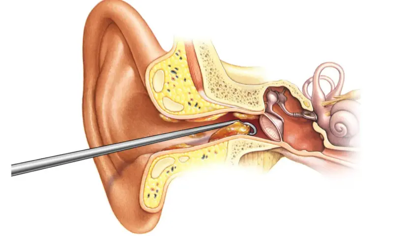 Instrumento extrae un tapón de cera del oído. El cerumen obstruye el canal auditivo, afectando la audición.