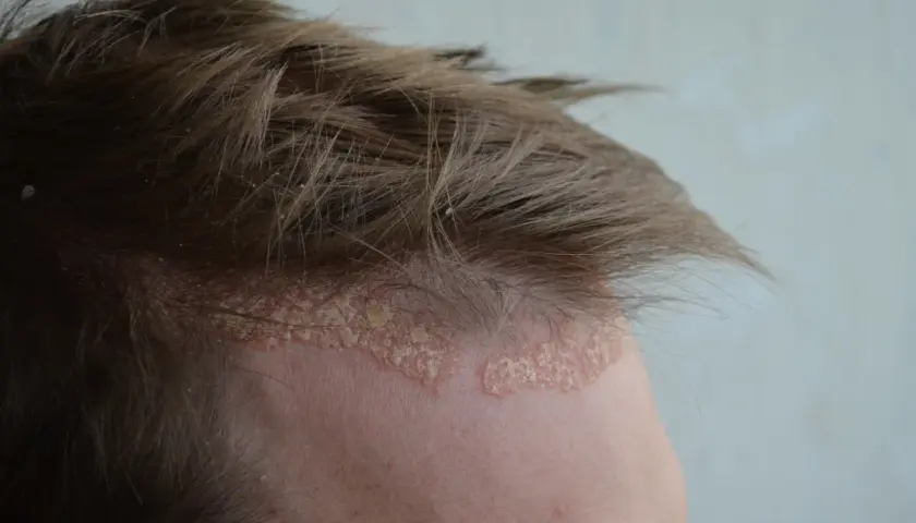 Dermatite seborroica e psoriasi sul cuoio capelluto: chiazze squamose e arrossate lungo l'attaccatura dei capelli.