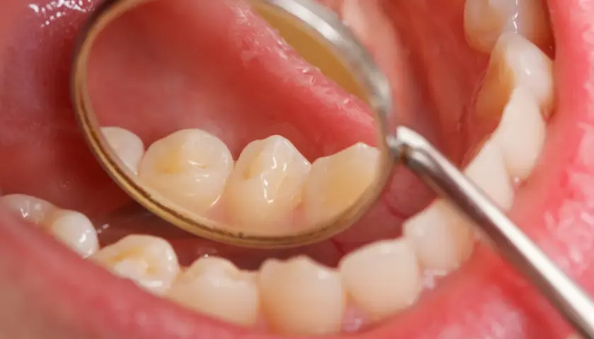 Widok jamy ustnej z lusterkiem dentystycznym, uwidaczniającym białe plamy na zębach.