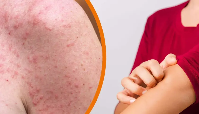Rote, entzündete Haut mit vielen kleinen Pickelchen am Arm, die jucken. Hitzepickel am Arm sind unangenehm.