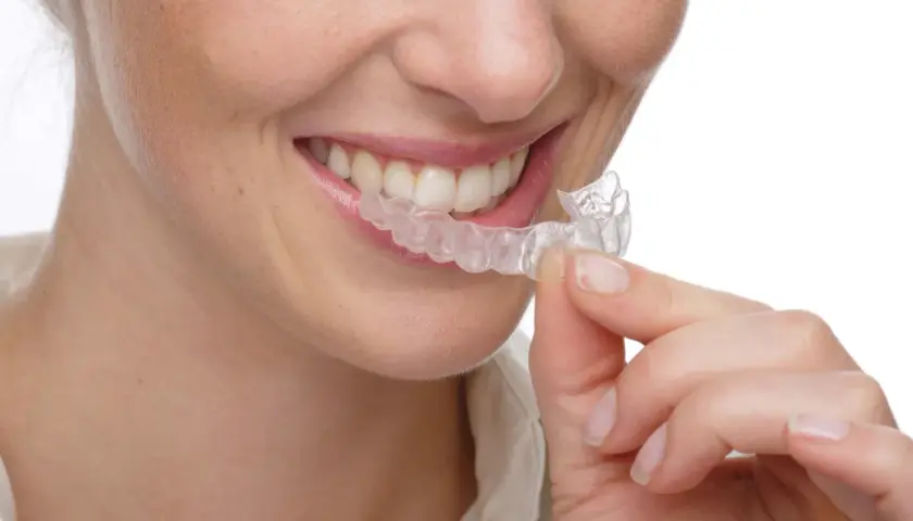 Sonrisa de mujer con férulas transparentes. A pesar de que los **invisalign duelen** un poco al principio, la sonrisa vale la pena.