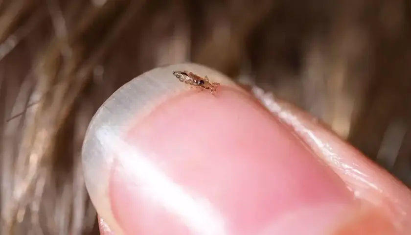 Un pidocchio, piccolo e scuro, si aggrappa a un'unghia. Forse il phon uccide i pidocchi, ma questo è ancora vivo.