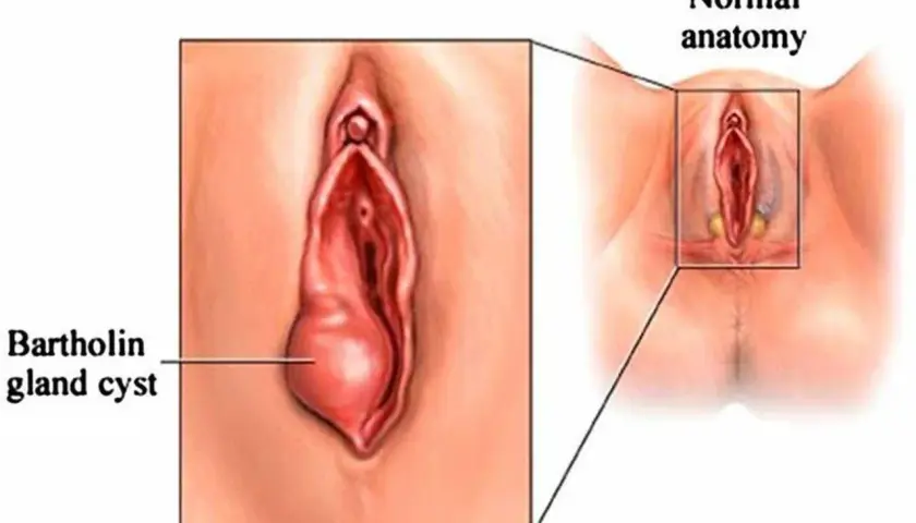 Powiększony gruczoł Bartholina po lewej, po prawej normalna anatomia.