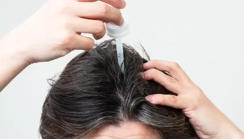 Persona aplica un gotero en su cuero cabelludo, buscando alternativas al minoxidil para el crecimiento capilar.