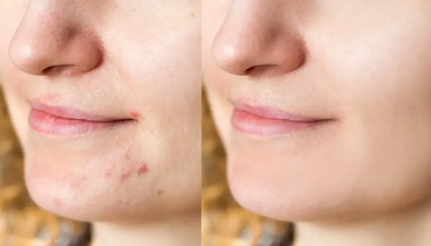 Avant/après : une peau avec des boutons et des pores dilatés devient lisse et nette. Découvrez comment faire disparaitre un bouton pour un teint parfait.