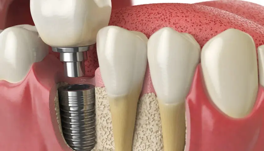 Impianto dentale che sostituisce un dente mancante, soluzione per l'edentulia.