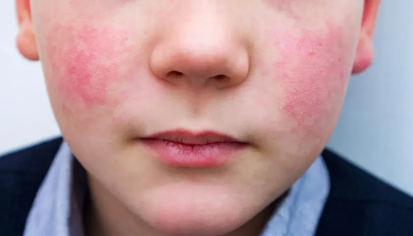 Primo piano del viso di un bambino con guance rosse e calde, forse per il freddo o un'allergia. La pelle appare leggermente screpolata.