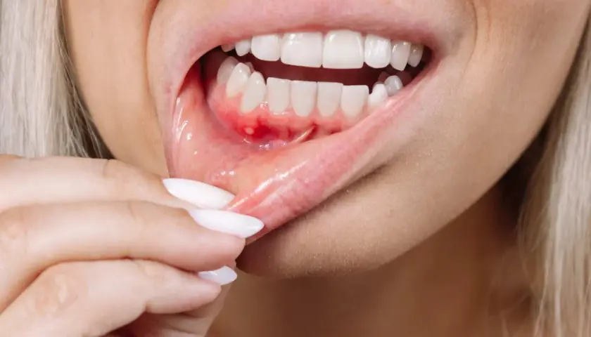 Detalle de una boca con úlceras y enrojecimiento, mostrando posibles causas de boca irritada por dentro.