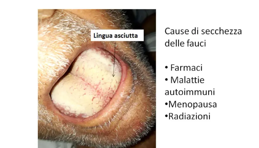 Lingua secca e pallida, sintomo di gola asciutta. Cause: farmaci, malattie autoimmuni, menopausa, radiazioni.